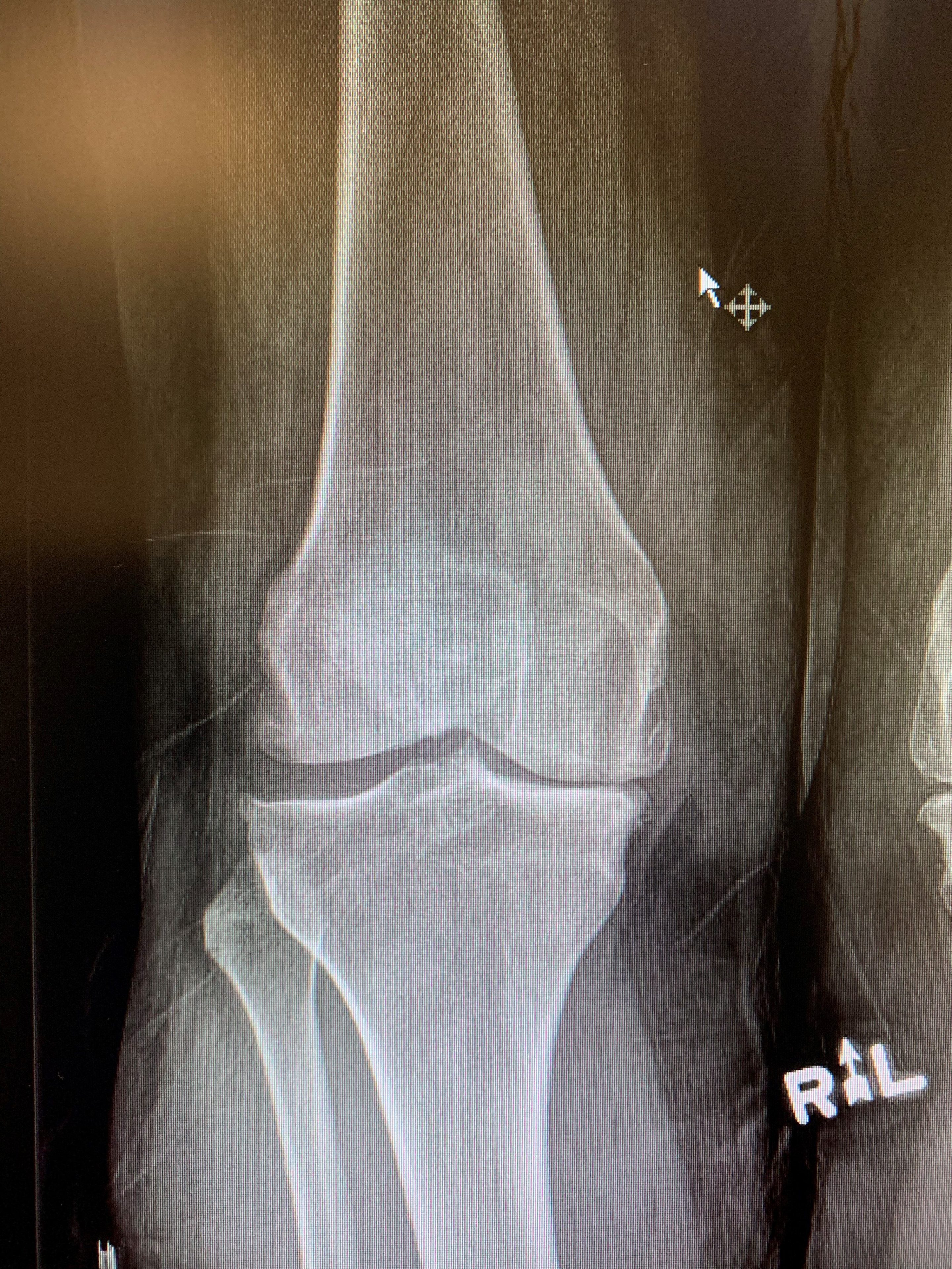 Reemplazo primario de rodilla navegado por computadoraa