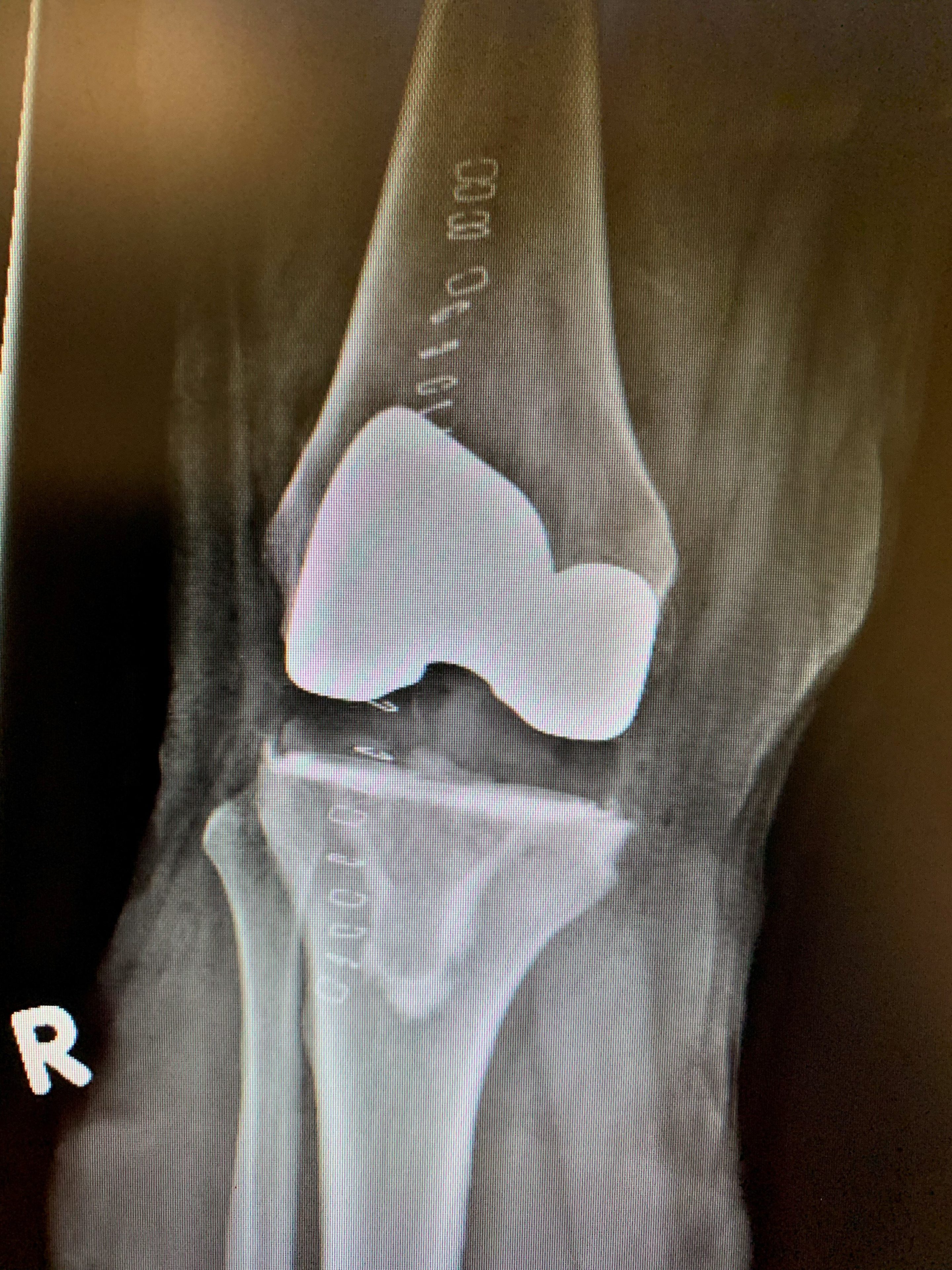 Reemplazo primario de rodilla navegado por computadorab