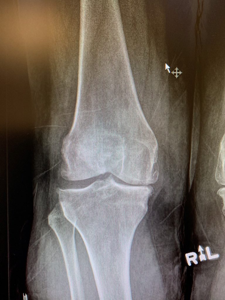 Reemplazo primario de rodilla con instrumentación personalizada en una malea de 63 años