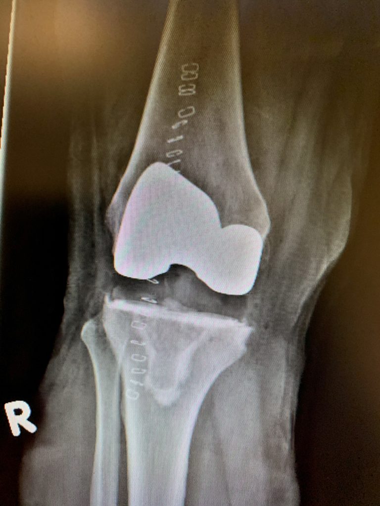 Reemplazo primario de rodilla con instrumentación personalizada en un hombre de 63 años