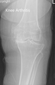 Radiografía preoperatoria de la rodilla izquierda que muestra AP y vistas laterales