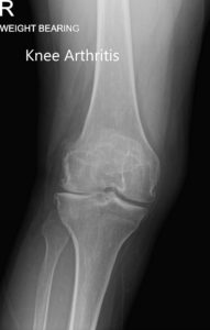 Radiografía preoperatoria con soporte de peso que muestra AP y vistas laterales de la rodilla derecha