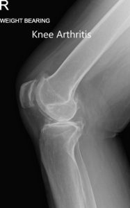 Radiografía preoperatoria con soporte de peso que muestra AP y vistas laterales de la rodilla derecha - img 2