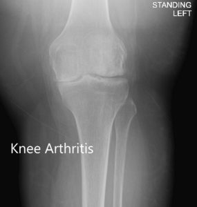 Vista anteroposterior y lateral de la rodilla izquierda