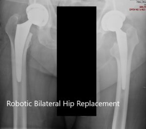 Radiografía postoperatoria de la pelvis del paciente con ambas caderas