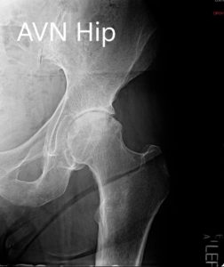 Radiografía preoperatoria que muestra la PA y las vistas laterales de la cadera izquierda