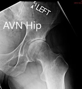 Radiografía preoperatoria que muestra el AP y las vistas laterales de la cadera izquierda - img 2