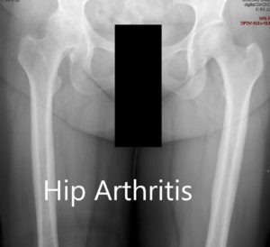 Radiografía preoperatoria que muestra la vista AP de la pelvis con ambas articulaciones de la cadera