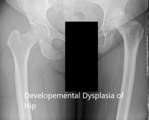 Radiografía que muestra la vista AP de la pelvis con ambas articulaciones de la cadera 