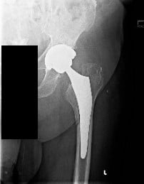 Radiografía preoperatoria de la cadera izquierda Vista AP que muestra una fractura femoral periprotésica (mínimamente desplazada a lo largo de la cara medial del eje femoral proximal) con hundimiento del vástago