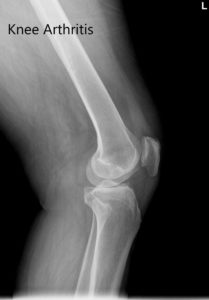 Radiografía preoperatoria de la rodilla izquierda que muestra AP y vistas laterales