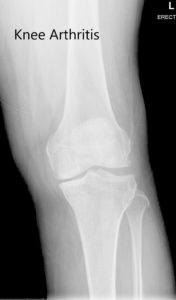 Radiografía preoperatoria de la rodilla izquierda que muestra AP y vistas laterales - img 2