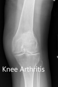 Radiografía preoperatoria que muestra la vista AP de la rodilla izquierda y derecha, respectivamente