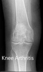 Radiografía preoperatoria que muestra la vista AP de la rodilla izquierda y derecha respectivamente - img 2
