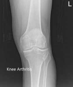 Radiografía preoperatoria de la rodilla izquierda que muestra vistas AP, laterales y mercantiles