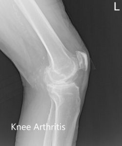 Radiografía preoperatoria de la rodilla izquierda que muestra AP, vistas laterales y mercantiles - img 2
