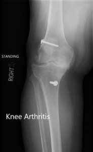 Radiografía preoperatoria que muestra la AP y las vistas laterales de la rodilla derecha con tornillos retenidos consistentes con la reconstrucción del LCA