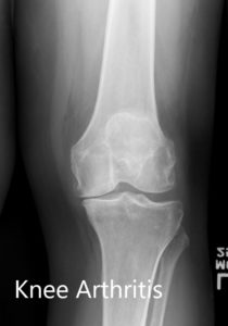 Radiografía preoperatoria de la rodilla izquierda que muestra AP y vistas laterales