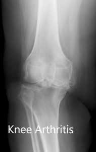 Radiografía preoperatoria de la rodilla derecha que muestra AP y vistas laterales