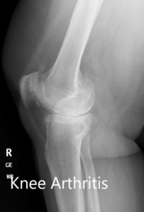 Radiografía preoperatoria de la rodilla derecha que muestra AP y vistas laterales - img 2