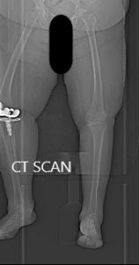 Imagen topográfica de las extremidades inferiores de los pacientes, lo que sugiere osteoartritis tricompartimental grave de la rodilla izquierda