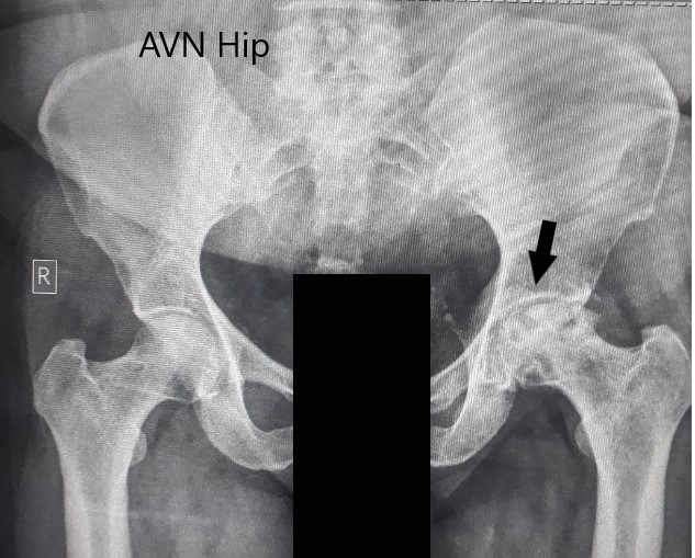 Radiografía preoperatoria de la pelvis con ambas caderas en vista anteroposterior que muestra cambios en la AVN en la cadera izquierda