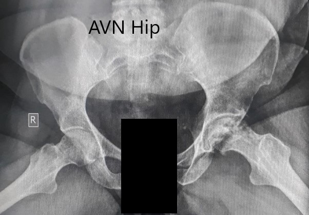 Radiografía preoperatoria de la pelvis con ambas caderas en la vista lateral con patas de rana que muestra cambios en la AVN en la cadera izquierda