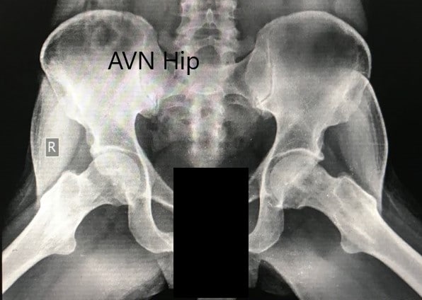 Radiografía preoperatoria de la pelvis con ambas caderas en la vista lateral de patas de rana que muestra AVN de las caderas bilaterales