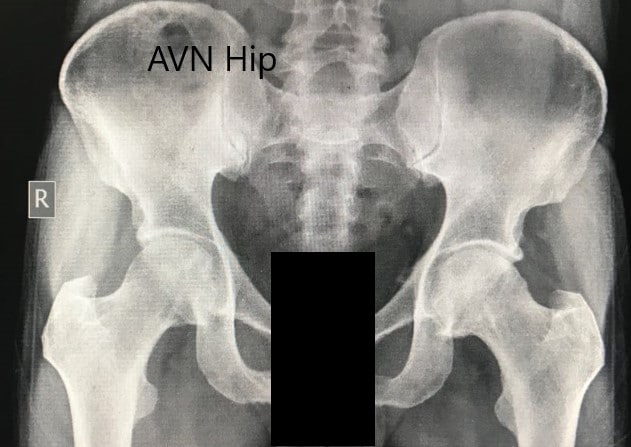 Radiografía preoperatoria de la pelvis con ambas caderas en vista anteroposterior que muestra AVN de las caderas bilaterales