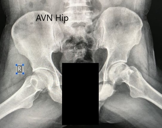 Radiografía preoperatoria de la pelvis con ambas caderas en la vista lateral de patas de rana que muestra AVN de la cadera izquierda
