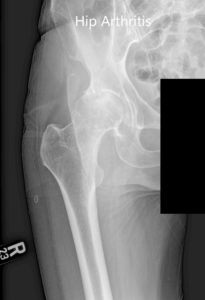 AP preoperatoria y vistas laterales de la articulación de la cadera derecha