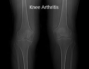 Radiografía preoperatoria que muestra la vista AP de las articulaciones bilaterales de la rodilla