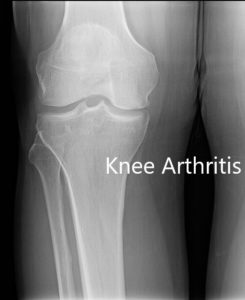 Radiografía preoperatoria que muestra AP y vista lateral de la articulación de la rodilla derecha, y vista del horizonte de ambas articulaciones de la rodilla