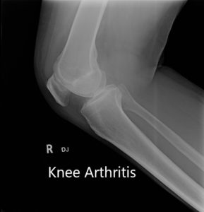 Radiografía preoperatoria que muestra AP y vista lateral de la articulación de la rodilla derecha, y vista del horizonte de ambas articulaciones de la rodilla - img 2