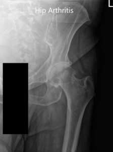Radiografía preoperatoria de la cadera izquierda que muestra PA y vista lateral con patas de rana