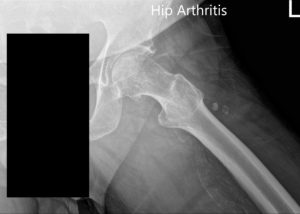 Radiografía preoperatoria de la cadera izquierda que muestra PA y vista lateral con patas de rana - img 2