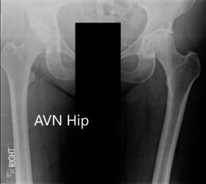 Radiografía que muestra la vista AP de la pelvis con ambas articulaciones de la cadera