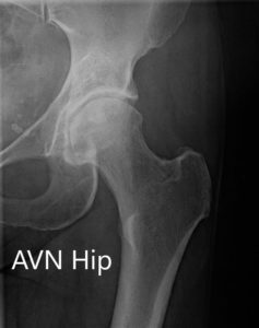 Radiografía que muestra la AP y las vistas laterales con patas de rana de la articulación de la cadera izquierda