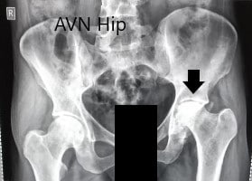 Radiografía preoperatoria de la pelvis con ambas caderas en vista anteroposterior