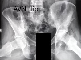 Radiografía preoperatoria de la pelvis con ambas caderas en vistas laterales con patas de rana