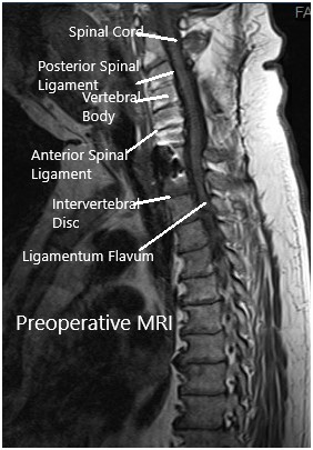 Resonancia magnética preoperatoria en la sección sagital