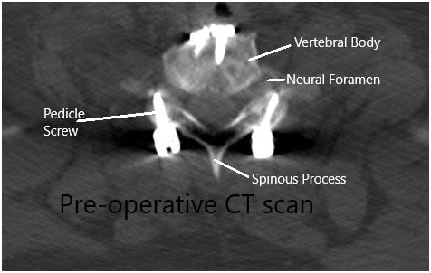 Tomografía computarizada preoperatoria en la sección axial