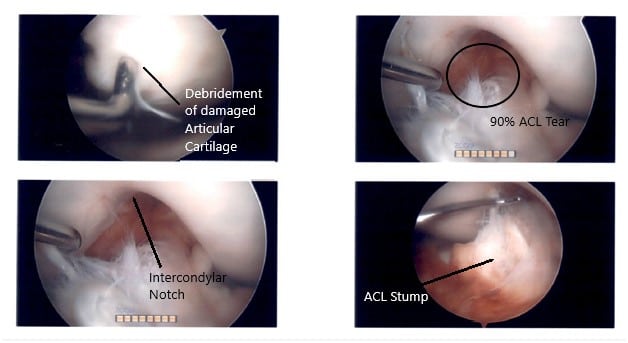 Imágenes artroscópicas intraoperatorias de la rodilla izquierda