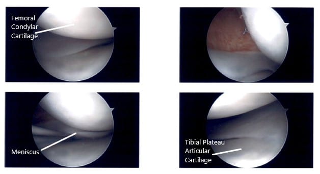 Imágenes artroscópicas intraoperatorias de la rodilla izquierda 2