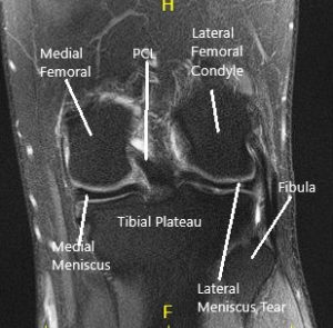 Resonancia magnética de la rodilla en secciones coronal y sagital