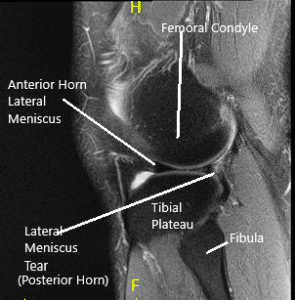 Resonancia magnética de la rodilla en secciones coronal y sagital 2