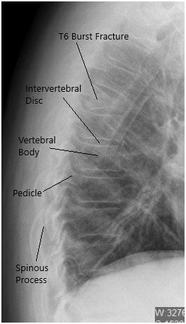 Radiografía preoperatoria de la columna toracolumbar en vista lateral