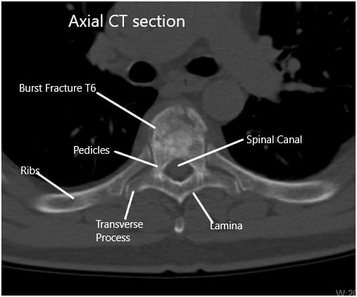 Tomografía computarizada preoperatoria de la columna toracolumbar en sección axial en T6