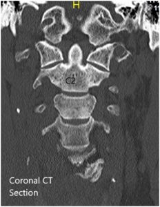 Secciones preoperatorias de TC coronal y axial