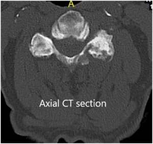 TC coronal y axial preoperatoria 2